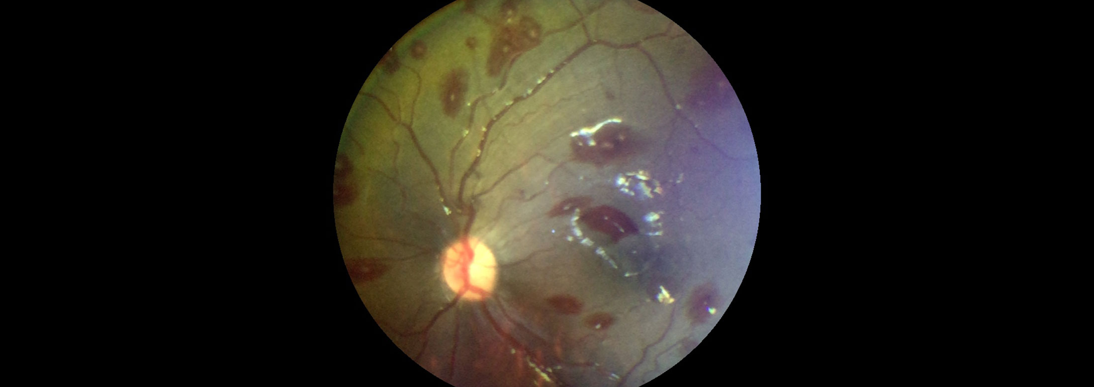 Retina with CM